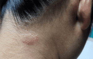 What is the Spiritual Meaning Of Ringworm 1
